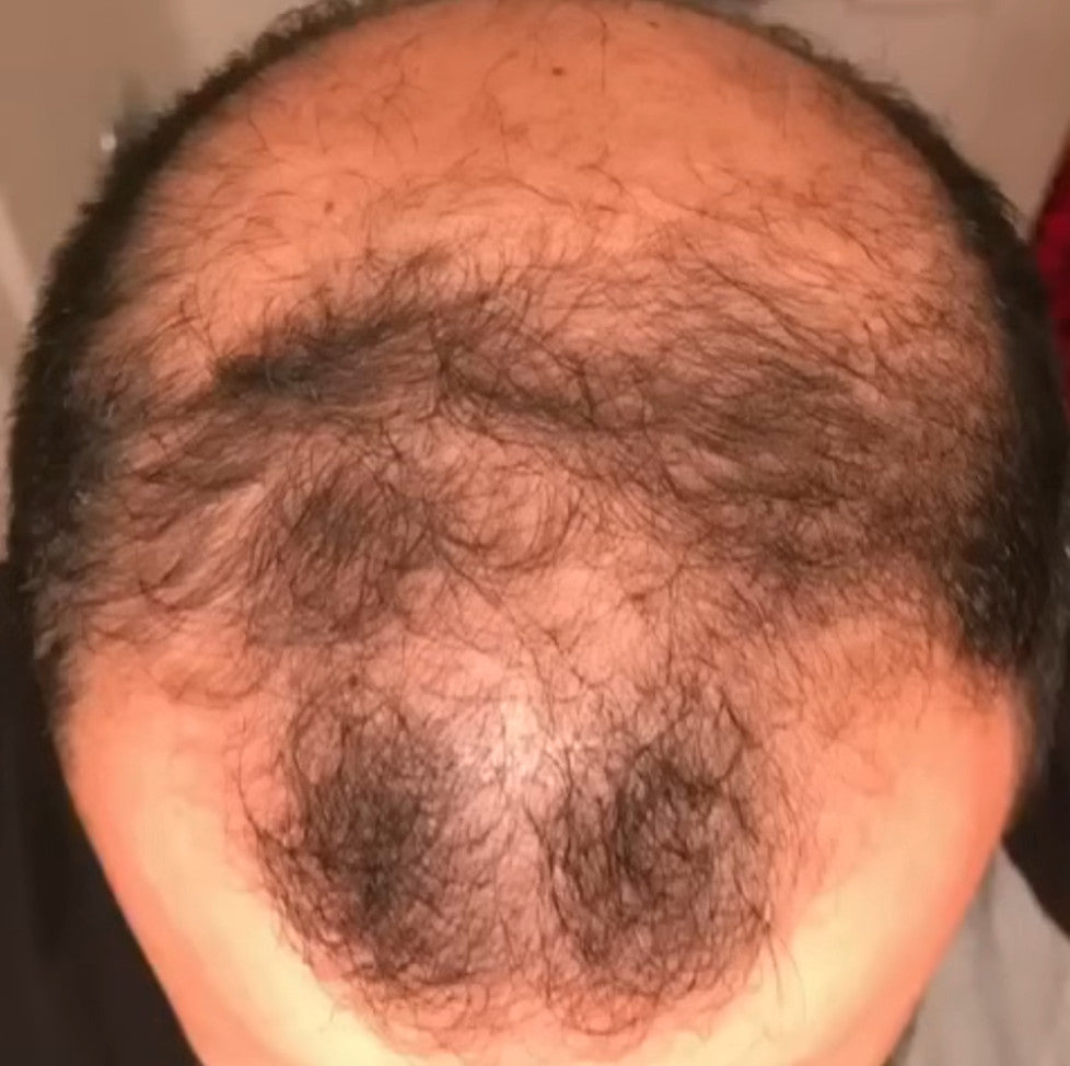 Baseline photo before hair serum and microneedling