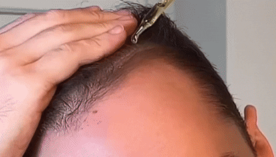 Applying hai serum after micrlneedling improve absorption