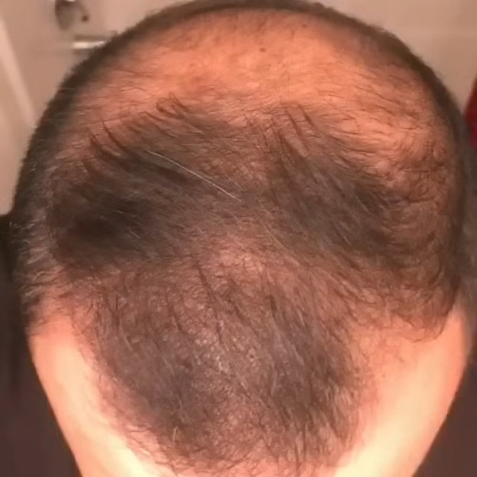 Hair regrowth after the serum and microneedling