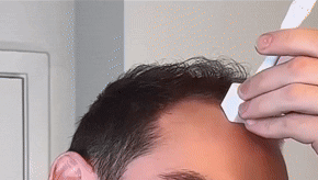 Microneedling stamp on the scalp